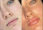 Best Aesthetic Clinics in dubai for Fillers: How to Achieve Natural, Youthful Results