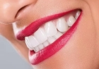 Tooth Crowns in Dubai: A Comprehensive Overview of the Procedure