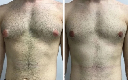 How to Finance Your Gynecomastia Surgery in Dubai