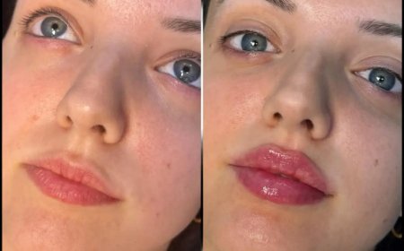 Best Doctors in dubai for Fillers: Combining Filler Treatments with Botox