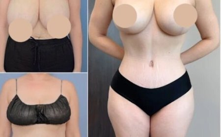 Best Tummy Tuck Surgeon in dubai: Achieving Your Ideal Body