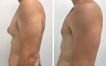 5 Reasons to Choose the Best Gynecomastia Surgeons in dubai for Your Surgery