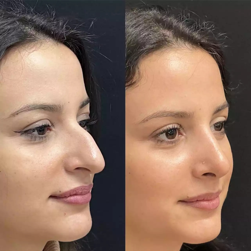 Best Septoplasty Surgeon in Dubai for Quick Recovery
