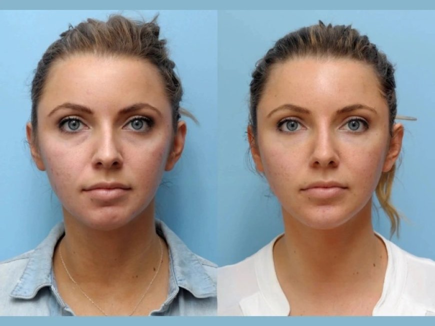 Best Doctors in Dubai for Thread Lift: Why It's the Ideal Non-Surgical Solution for Facial Rejuvenation