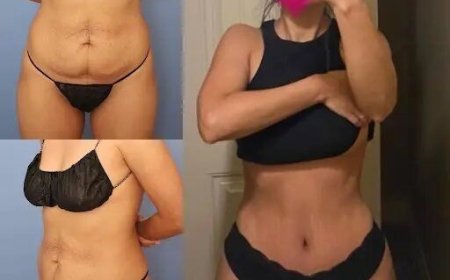 Post-Surgery Care for Tummy Tuck in Dubai: Essential Tips