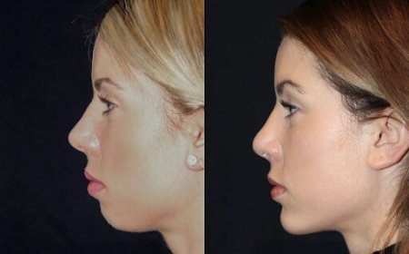 Best Aesthetic Clinics in dubai for Chin Fillers: Patient Safety and Hygiene